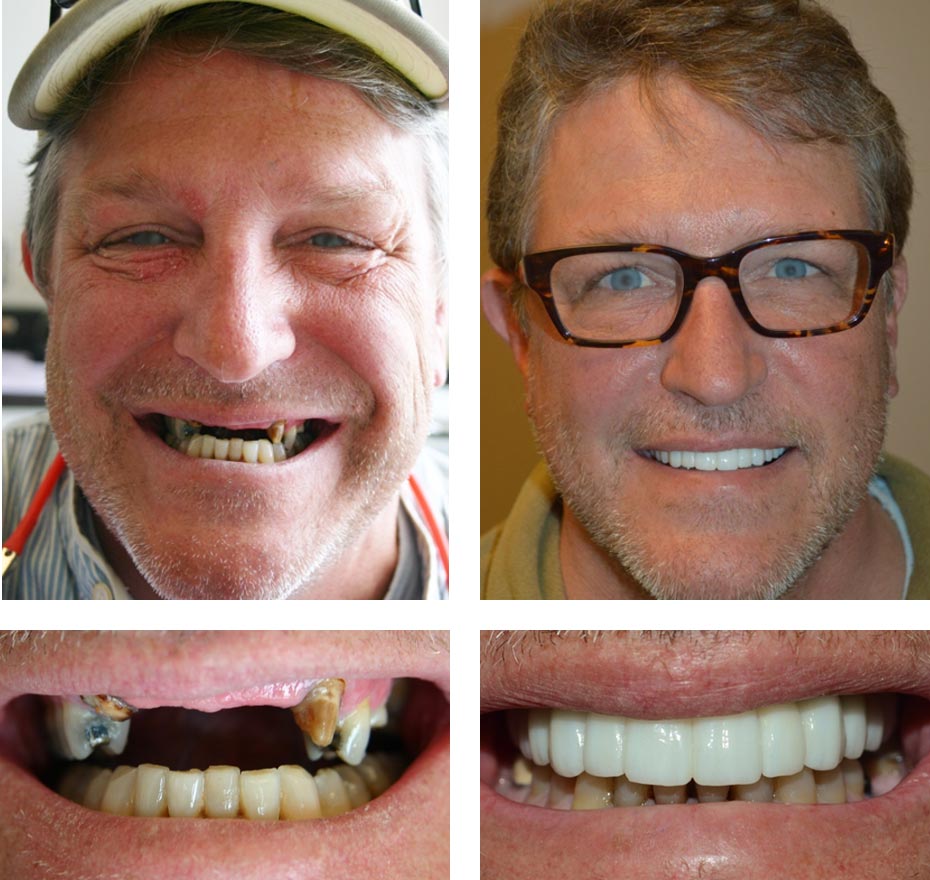 Replace Multiple Teeth, Implant Bridges Before and After 3, Alex Rabinovich at San Francisco Dental Implants