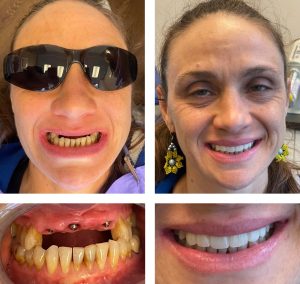 Replace Multiple Teeth, Implant Bridges Before and After 4, Alex Rabinovich at San Francisco Dental Implants