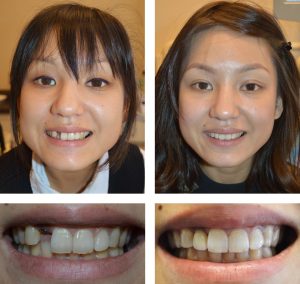 Replace Single Tooth, Implant Crowns Before and After 2, Alex Rabinovich at San Francisco Dental Implants