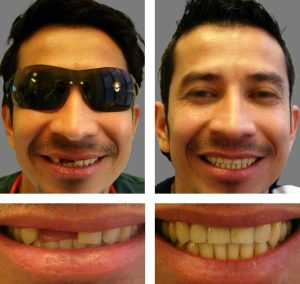 Replace Single Tooth, Implant Bridges Before and After 1, Alex Rabinovich at San Francisco Dental Implants