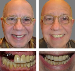 Replace Single Tooth, Implant Bridges Before and After 2, Alex Rabinovich at San Francisco Dental Implants