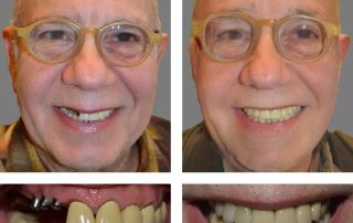 Replace Single Tooth, Implant Bridges Before and After 2, Alex Rabinovich at San Francisco Dental Implants
