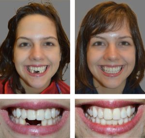 Replace Single Tooth, Implant Bridges Before and After 3, Alex Rabinovich at San Francisco Dental Implants