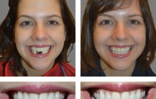 Replace Single Tooth, Implant Bridges Before and After 3, Alex Rabinovich at San Francisco Dental Implants