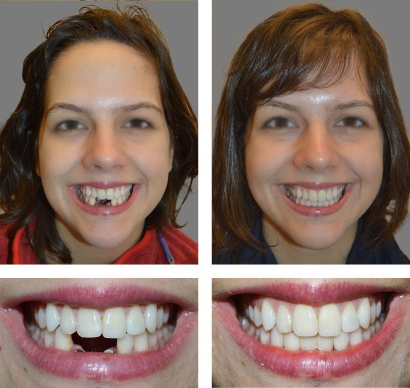 Single Tooth Implants | San Francisco Dental Implants Center