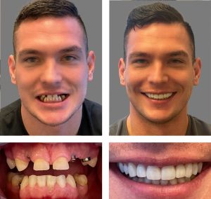 Replace Single Tooth, Implant Bridges Before and After 4, Alex Rabinovich at San Francisco Dental Implants
