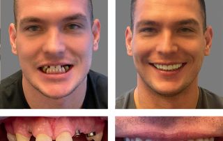 Replace Single Tooth, Implant Bridges Before and After 4, Alex Rabinovich at San Francisco Dental Implants
