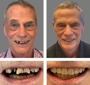 Replace Single Tooth, Implant Bridges Before and After 5, Alex Rabinovich at San Francisco Dental Implants