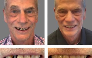 Replace Single Tooth, Implant Bridges Before and After 5, Alex Rabinovich at San Francisco Dental Implants