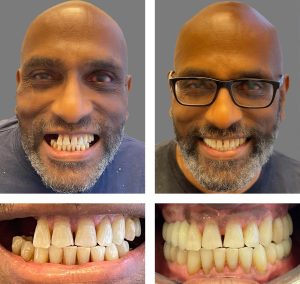 Replace Multiple Teeth, Implant Bridges Before and After 1, Alex Rabinovich at San Francisco Dental Implants