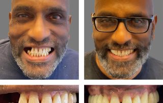 Replace Multiple Teeth, Implant Bridges Before and After 1, Alex Rabinovich at San Francisco Dental Implants