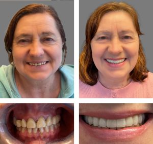 Replace Multiple Teeth, Implant Bridges Before and After 2, Alex Rabinovich at San Francisco Dental Implants