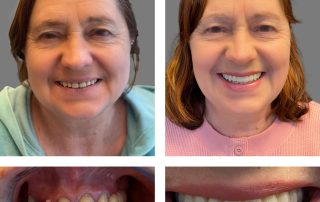 Replace Multiple Teeth, Implant Bridges Before and After 2, Alex Rabinovich at San Francisco Dental Implants