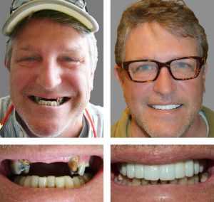 Replace Multiple Teeth, Implant Bridges Before and After 3, Alex Rabinovich at San Francisco Dental Implants patient results before and after