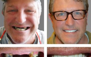 Replace Multiple Teeth, Implant Bridges Before and After 3, Alex Rabinovich at San Francisco Dental Implants patient results before and after