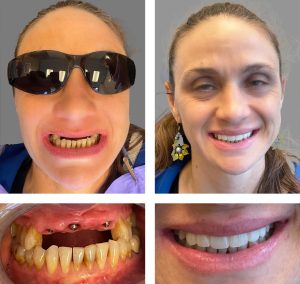 Replace Multiple Teeth, Implant Bridges Before and After 4, Alex Rabinovich at San Francisco Dental Implants