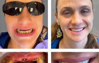 Replace Multiple Teeth, Implant Bridges Before and After 4, Alex Rabinovich at San Francisco Dental Implants