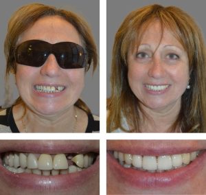 Replace Single Tooth, Implant Crowns Before and After 1, Alex Rabinovich at San Francisco Dental Implants before and after photos of patients