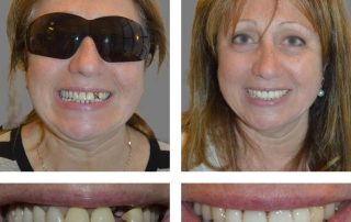 Replace Single Tooth, Implant Crowns Before and After 1, Alex Rabinovich at San Francisco Dental Implants before and after photos of patients