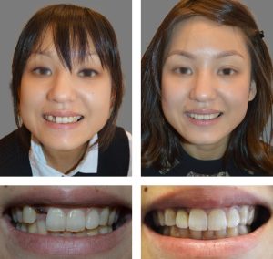 Replace Single Tooth, Implant Crowns Before and After 2, Alex Rabinovich at San Francisco Dental Implants