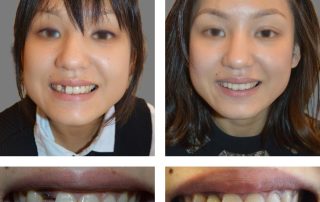 Replace Single Tooth, Implant Crowns Before and After 2, Alex Rabinovich at San Francisco Dental Implants