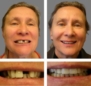 Replace Single Tooth, Implant Crowns Before and After 3, Alex Rabinovich at San Francisco Dental Implants