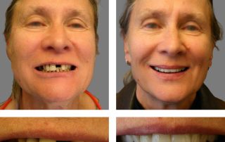 Replace Single Tooth, Implant Crowns Before and After 3, Alex Rabinovich at San Francisco Dental Implants